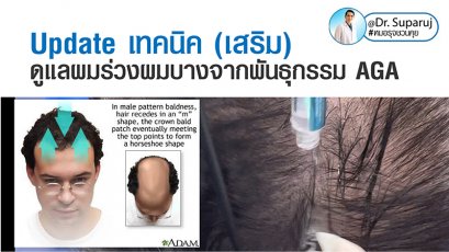 Update เทคนิค (เสริม)ดูแลผมร่วงผมบางจากพันธุกรรม AGA